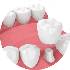 A diagram showing the dental crown process