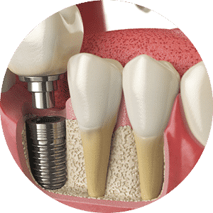 A graphic showing what a dental implants looks like