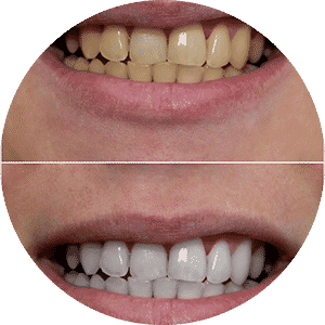 Photos of teeth whitening before and after