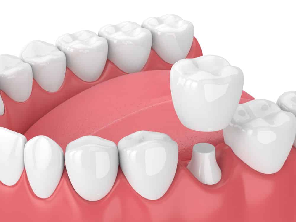 Tooth Crowns — Dental Crowns