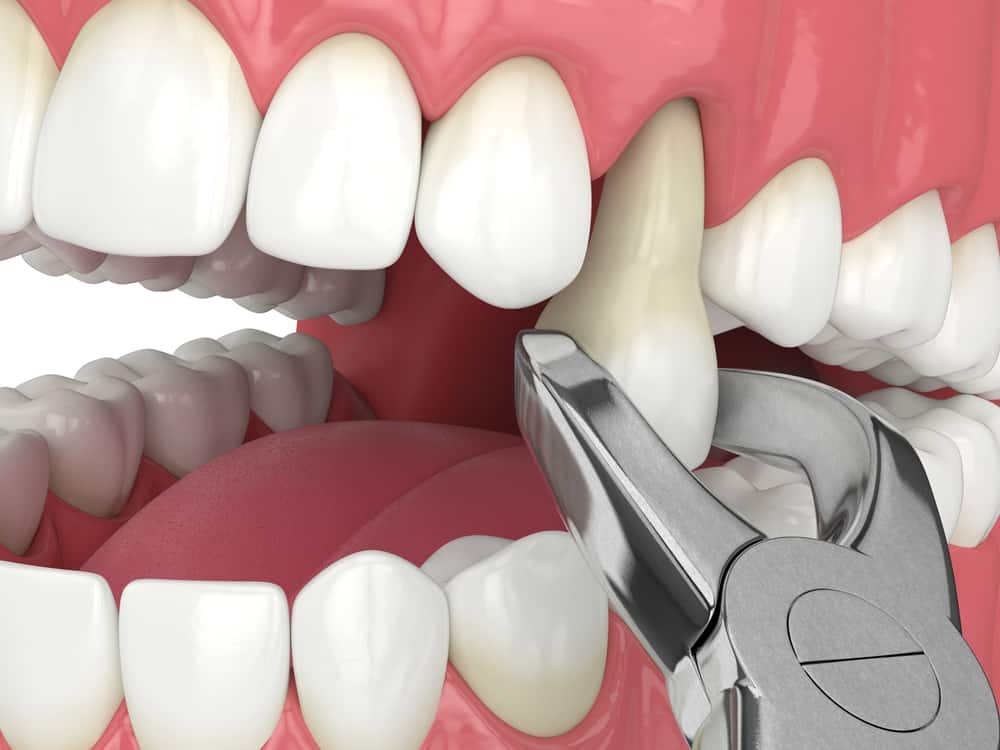 3d Tooth Extracted — Dental in Cardiff, NSW