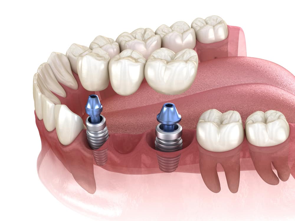 A graphic of the process of a Dental Implant