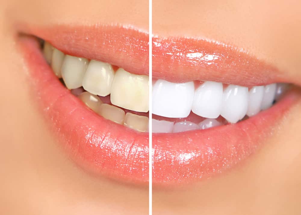 Before and after Teeth Whitening at our Cosmetic Dentist in Newcastle
