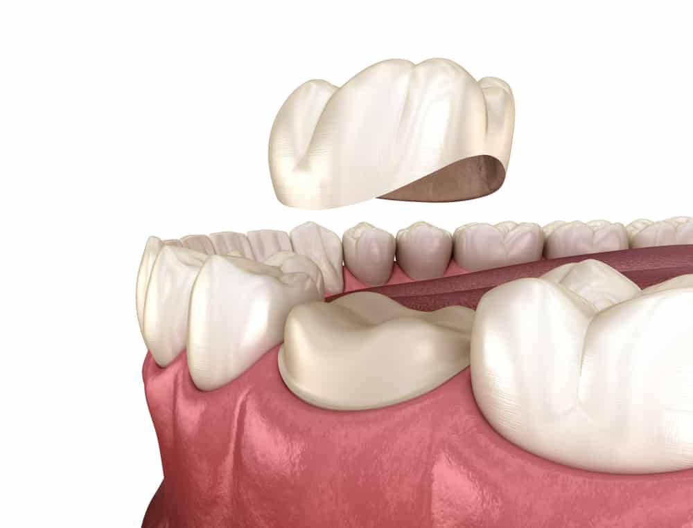 Tooth For Dental Crown Placement