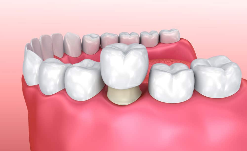 Dental Crown Installation Process
